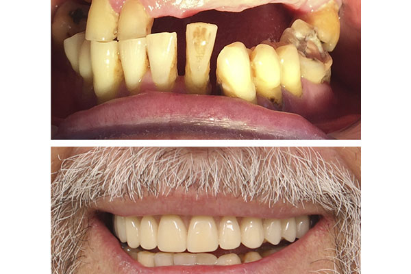 Implantes dentales maxilar e inferior