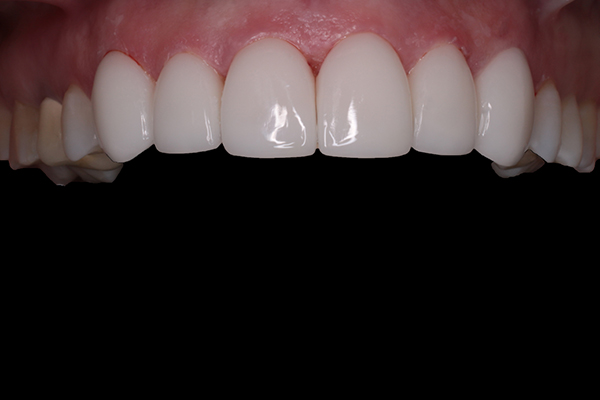 Coronas dentales de Zirconio
