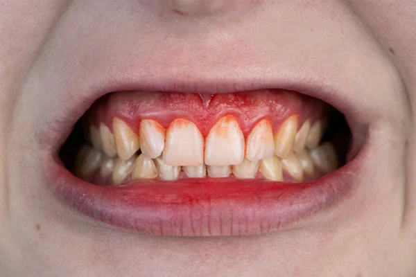 por-que-sangran-las-encias