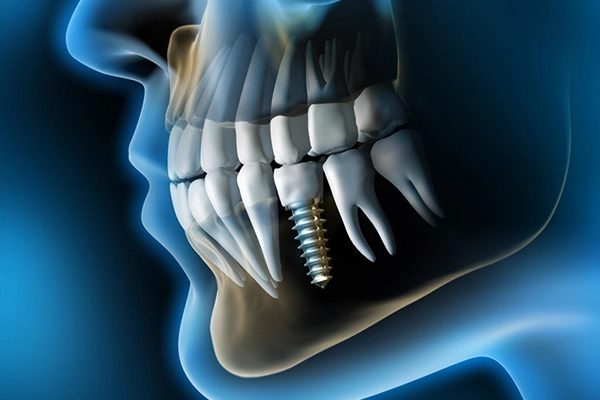enfermedades-por-implantes-dentales