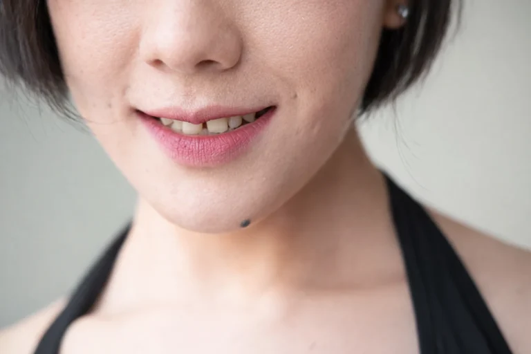 3 Formas de corregir la separación de los dientes delanteros