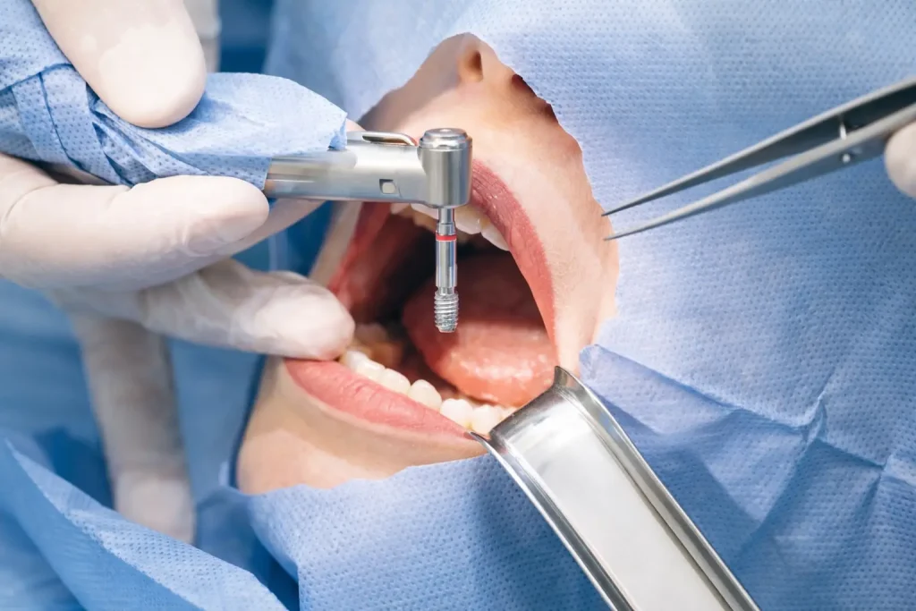 Costo de los implantes dentales en Colombia