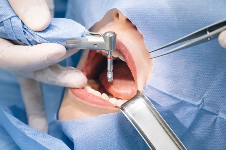 Costo de los implantes dentales en Colombia