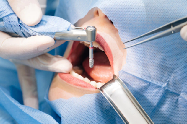 costo-de-los-implantes-dentales