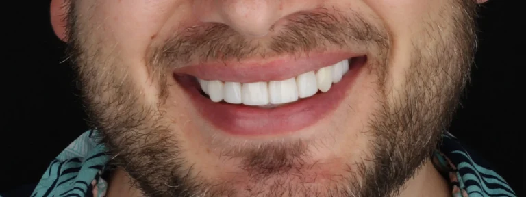 Microdiseño de sonrisa detalles que mejoran tu estética dental