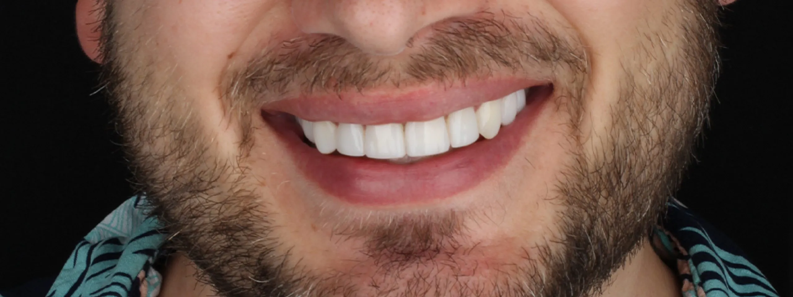 Microdiseño de sonrisa detalles que mejoran tu estética dental