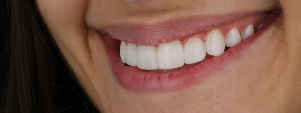 En qué consiste un diseño de sonrisa