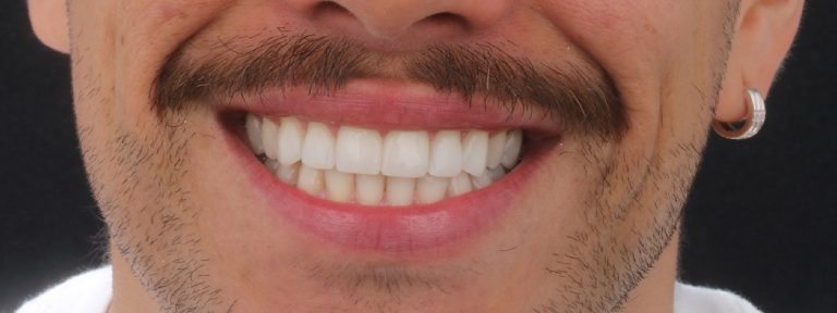 Tipos de blanqueamiento dental