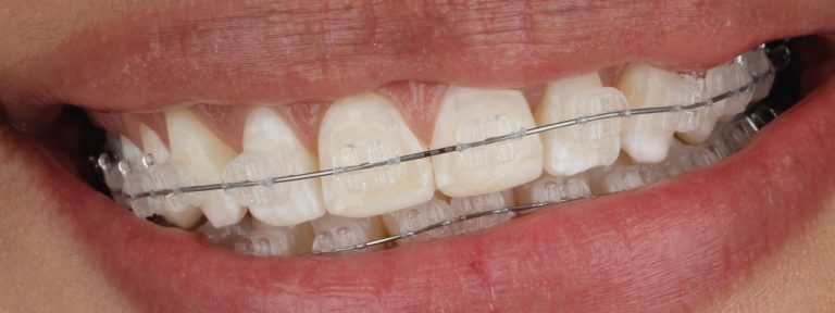 beneficios-esteticos-de-los-brackets-de-ceramica-1