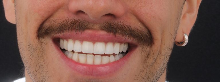 qué no hacer después de un diseño de sonrisa