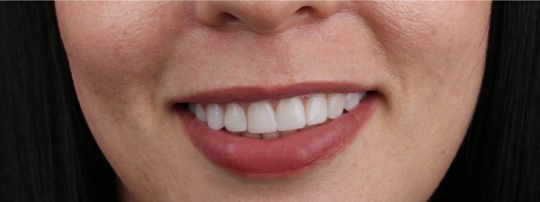 Blanqueamiento dental en Medellín