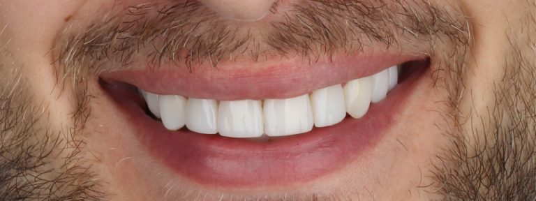 Diseño de sonrisa Medellín