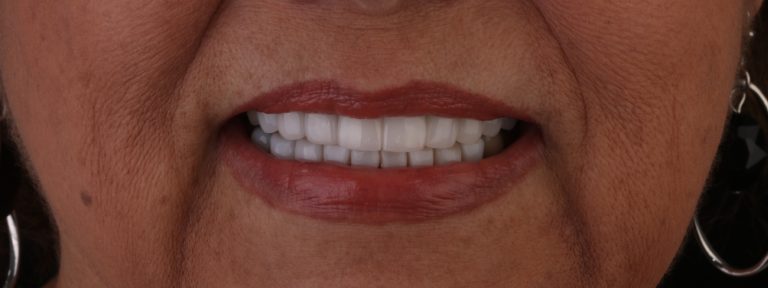 Implantes dentales colombia