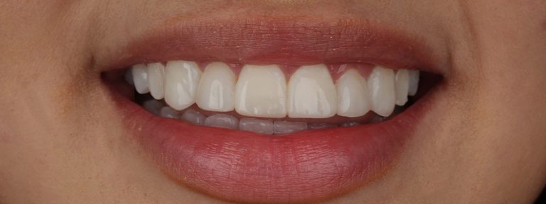 paciente con carillas en lente cerámico