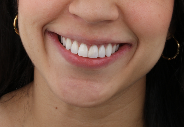 3 tipos de diseño de sonrisa en Medellín mujer muestra el resultado final del diseño de sonrisa hecho en OralStudio