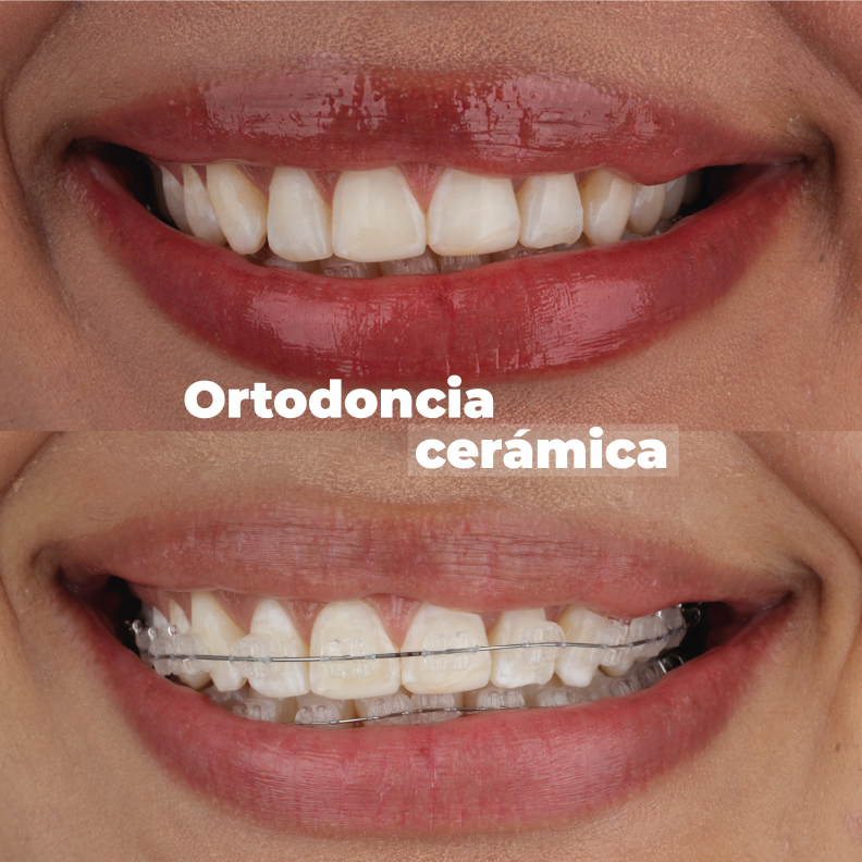 ortodoncia-en-medellin-cerámica-caso-1