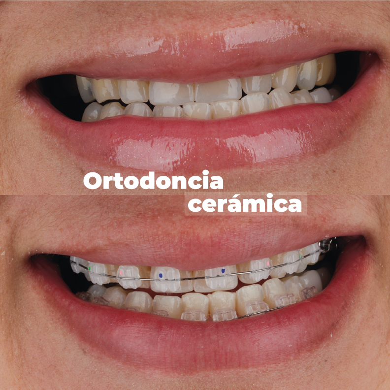 ortodoncia-en-medellin-cerámica-caso-2