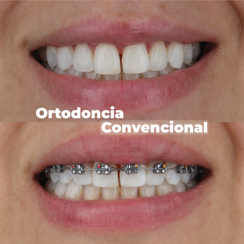 ortodoncia-en-medellin-convencional-caso-1