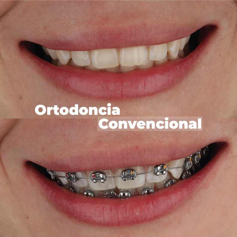 ortodoncia-en-medellin-convencional-caso-2