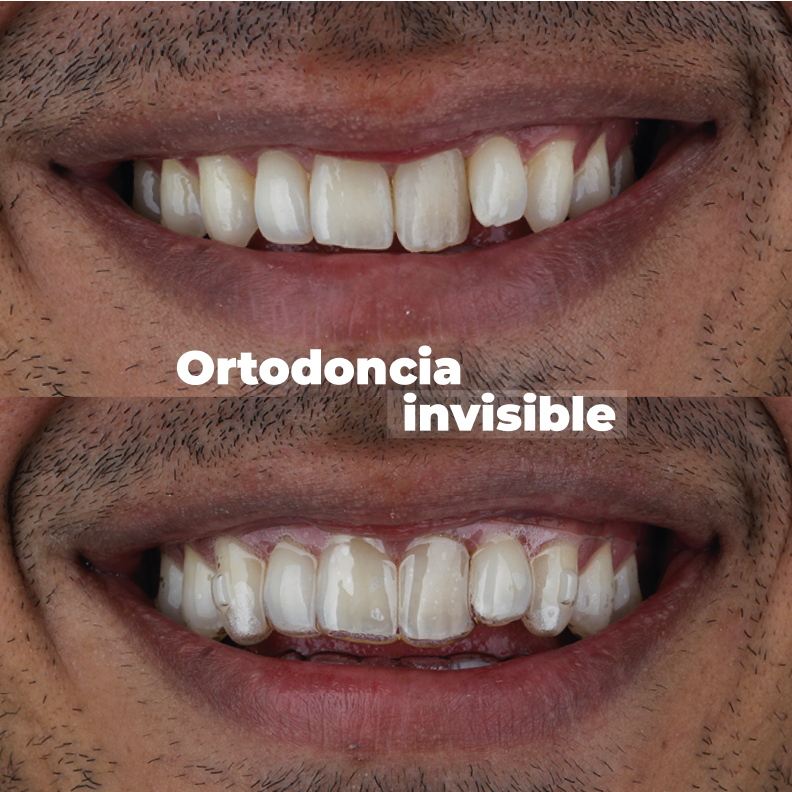 ortodoncia-en-medellin-invisible-caso-1