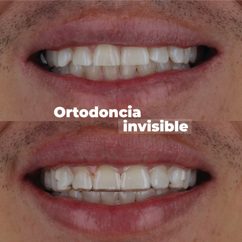 ortodoncia-en-medellin-invisible-caso-2