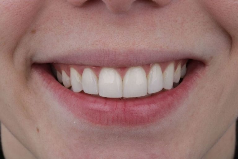 Mejores planes de blanqueamiento dental en Medellín paciente con blanqueamiento dental