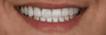 implantes-dentales-medellin-zona-estetica