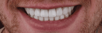 implantes-dentales-medellin-zona-estetica