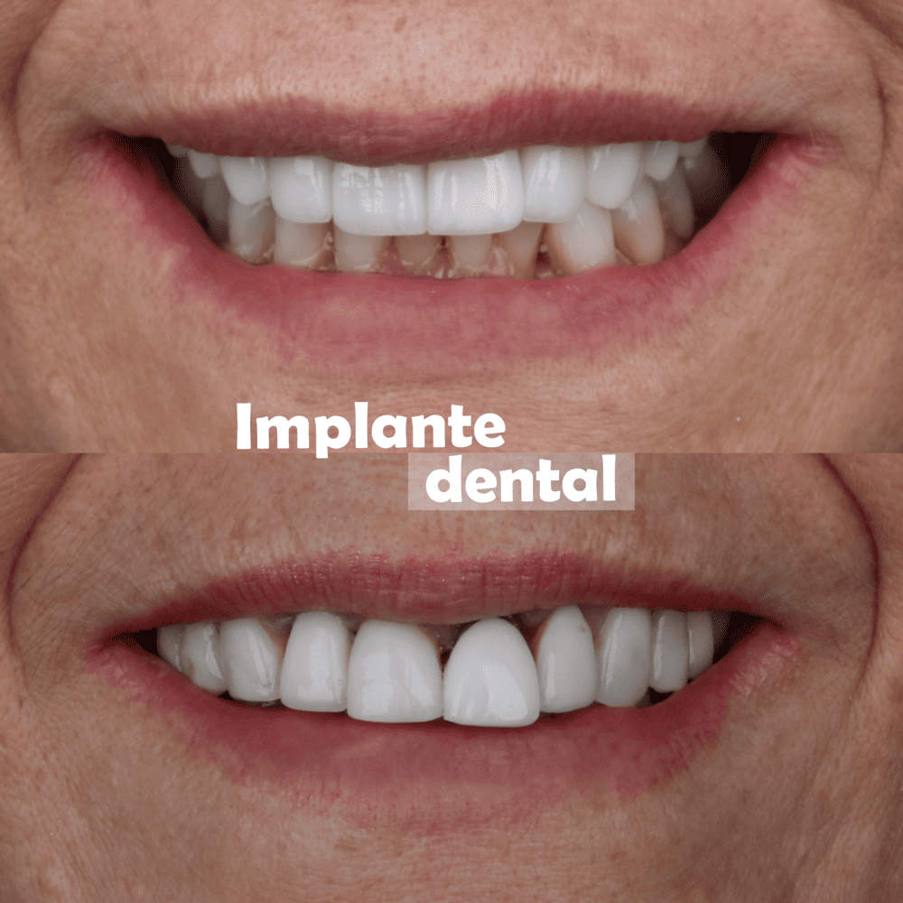 implantes-dentales-medellin-casos-exito-10