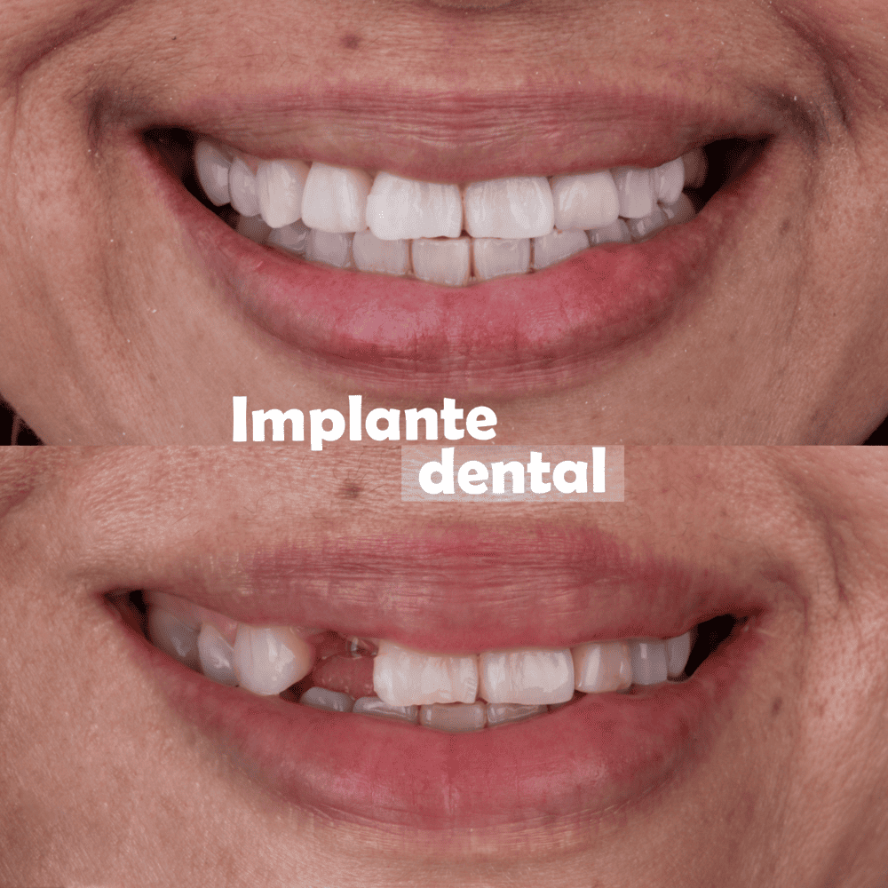 implantes-dentales-medellin-casos-exito-11
