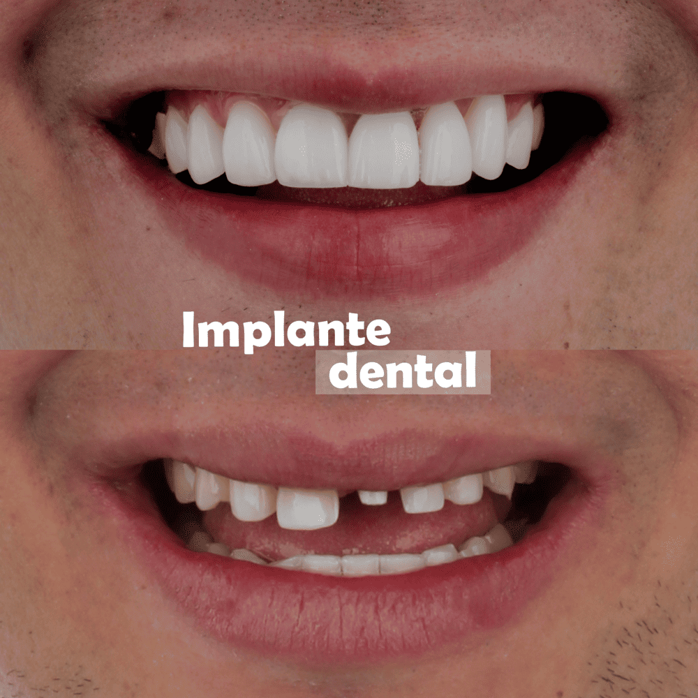 implantes-dentales-medellin-casos-exito-9