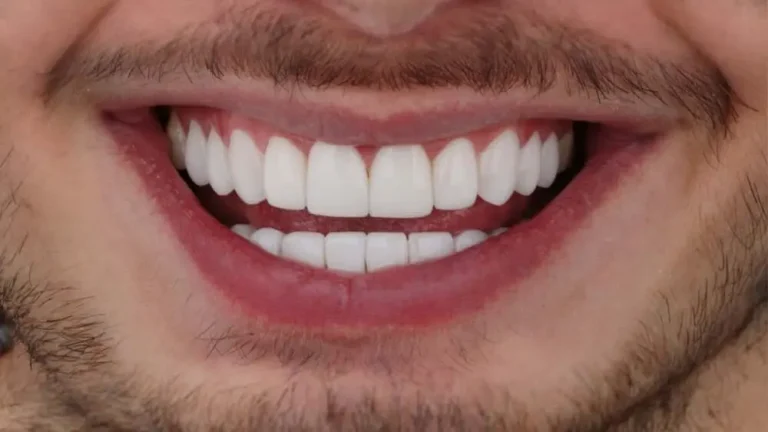 diseño-de-sonrisa-en-resina-o-ceramica