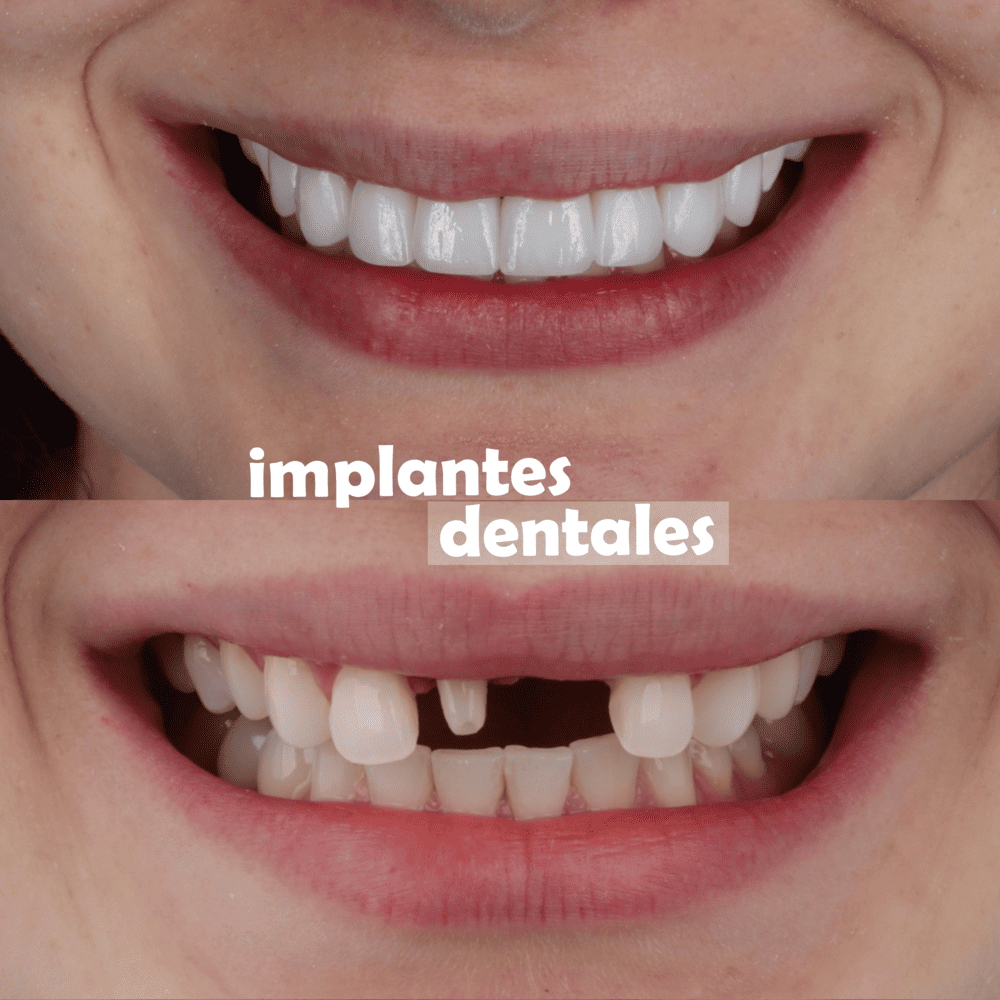 implantes-dentales-medellin-casos-exito-8