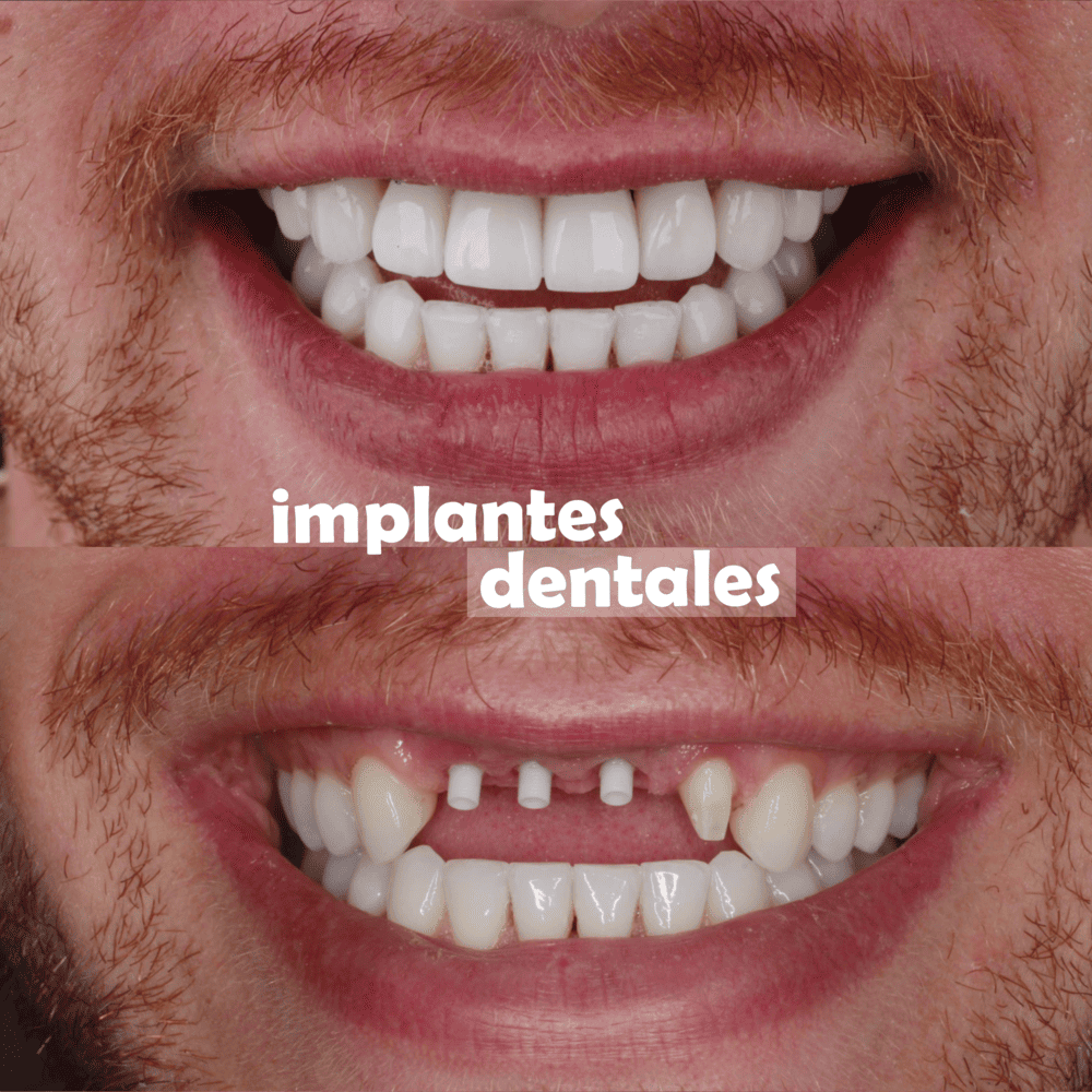implantes-dentales-medellin-casos-exito-12