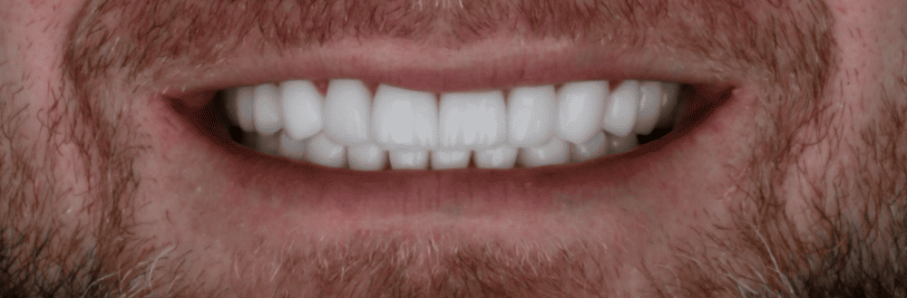 rehabilitación-oral-en-medellin-corona-metal-porcelana