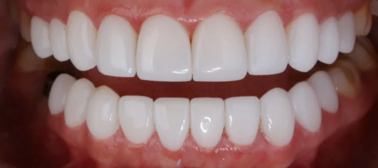 cuanto-cuesta-un-diseño-de-sonrisa