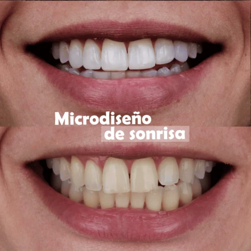 Microdiseño-de-sonrisa-en-medellin