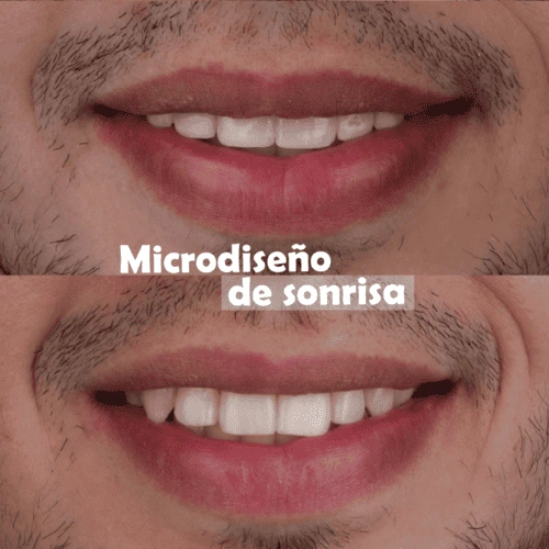 Microdiseño-de-sonrisa-medellin