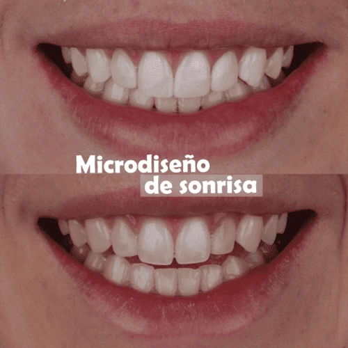 Microdiseño-de-sonrisa-medellin