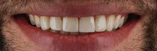 Microdiseño-de-sonrisa-medellin