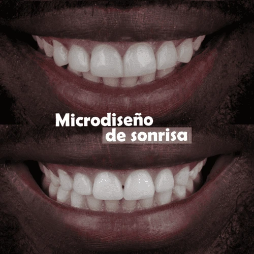 microdiseño-de-sonrisa-medellin