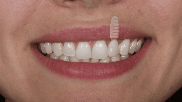 Implantes-de-carga-inmediata