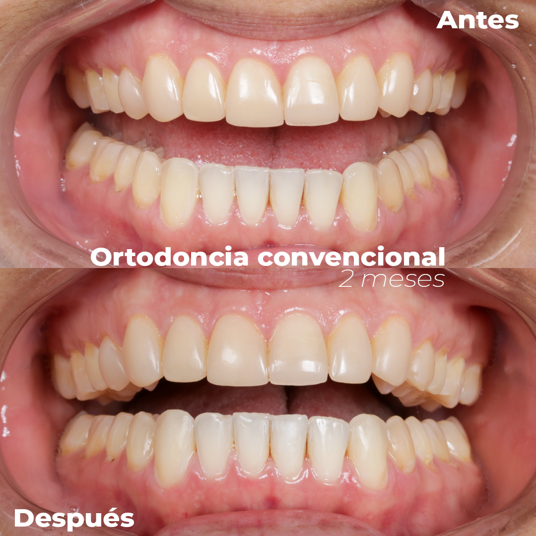 ORTODONCIA CONVENCIONAL, ORTODONCIA EN MEDELLIN, ALINEACION, RAPIDO