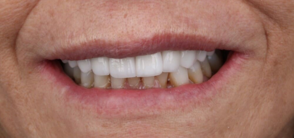 implantes de carga inmediata