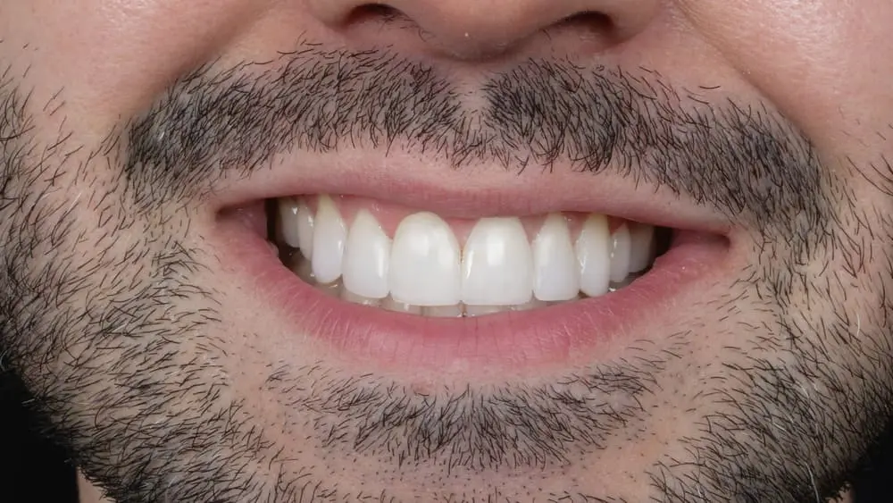 microdiseño-de-sonrisa-en-medellin