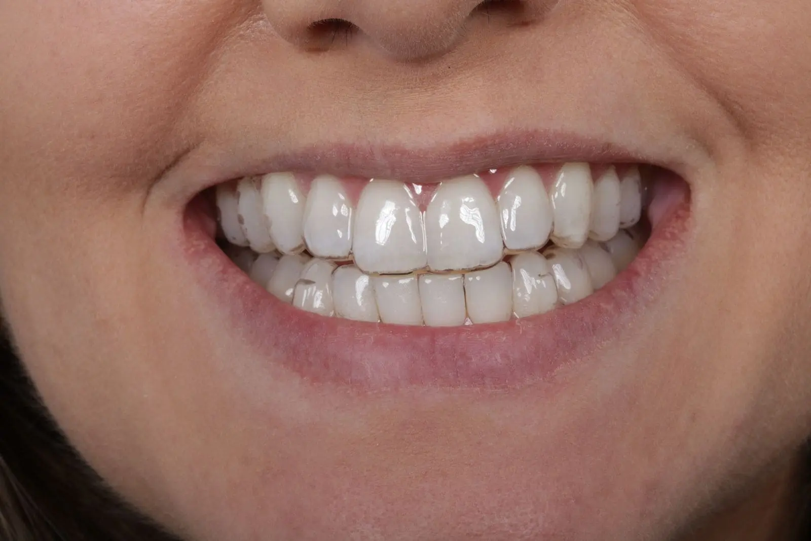 Ortodoncia-invisible