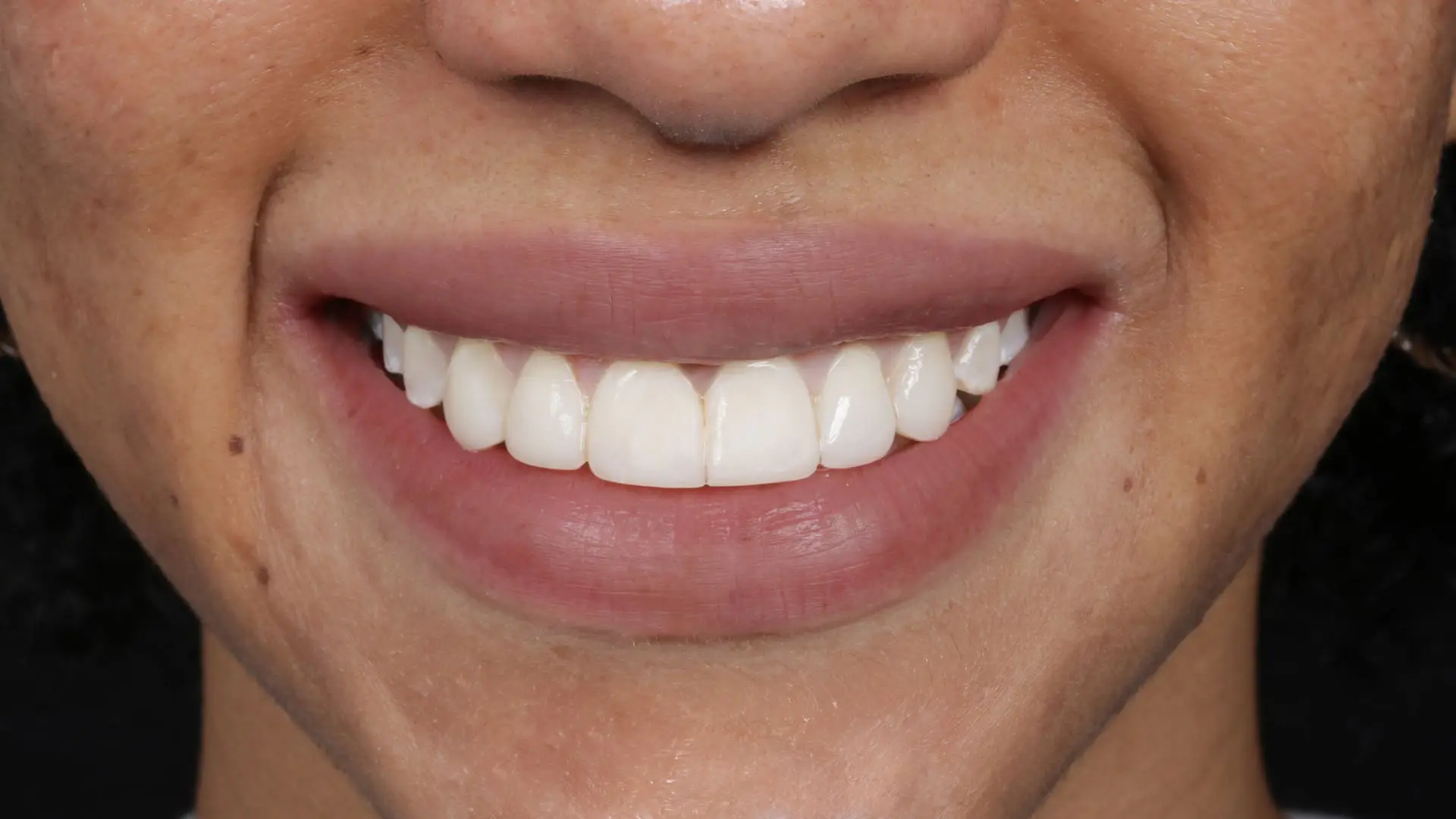 blanqueamiento-dental-en-medellin