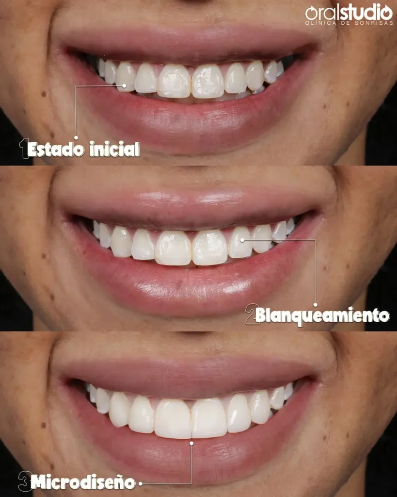 blanqueamiento-dental-en-medellin