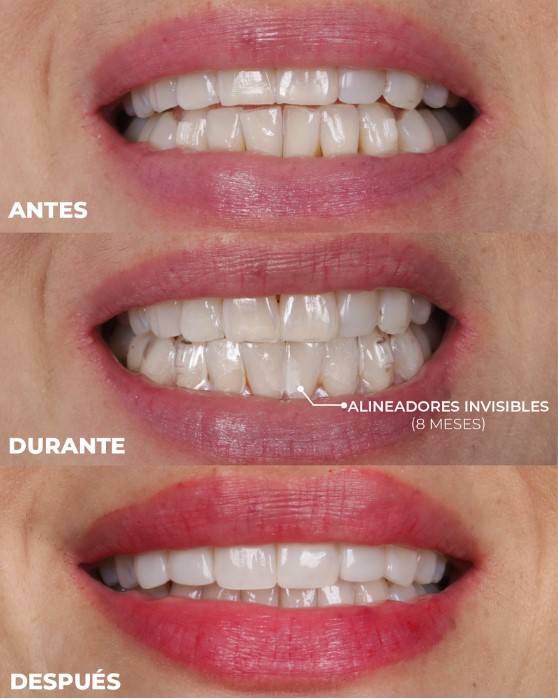 alineadores invisibles medellin oralstudio