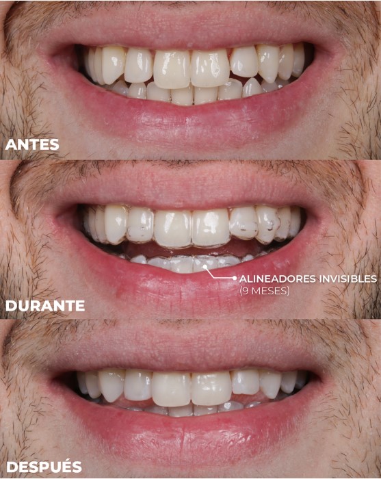 antes y despues de alineadores invisibles en medellin